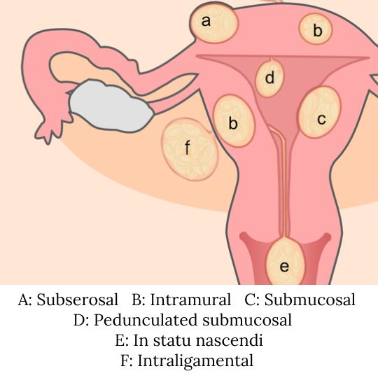 Diagram of a uterus showing the different fibroid types