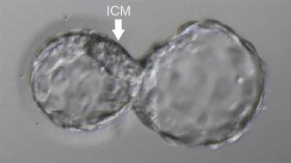 Blastocyst showing the 8-shaped hatching pattern, with the ICM around the hatching area, which resulted in a twin birth